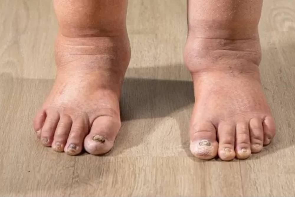 Kollarınızda veya bacaklarınızda şişlik varsa nedeni lenf&ouml;dem olabilir!